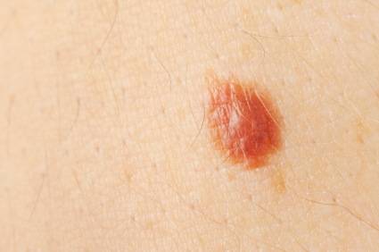 basal cell carcinoma skin cancer treatment mohs surgery miami