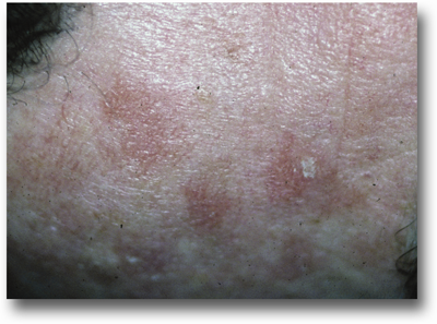 common skin cancer areas