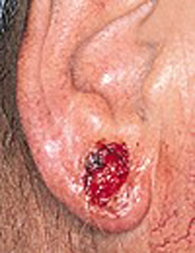 skincancer_slide0023_image034 Basal Cell Carcinoma Warning Signs