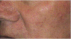 skincancer_slide0041_image083