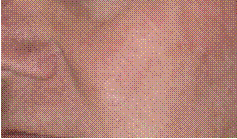 skincancer_slide0041_image085